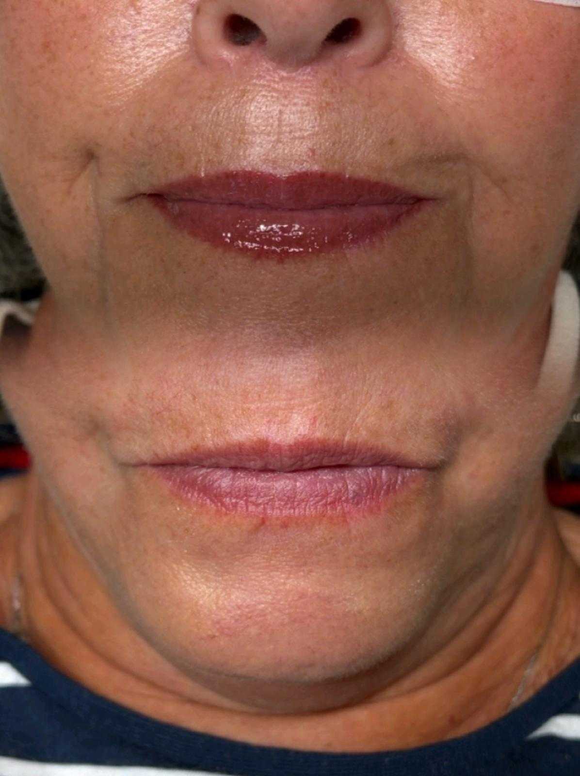 Semi-permanent makeup — lip blush — Healed lip blush adding colour and definition.