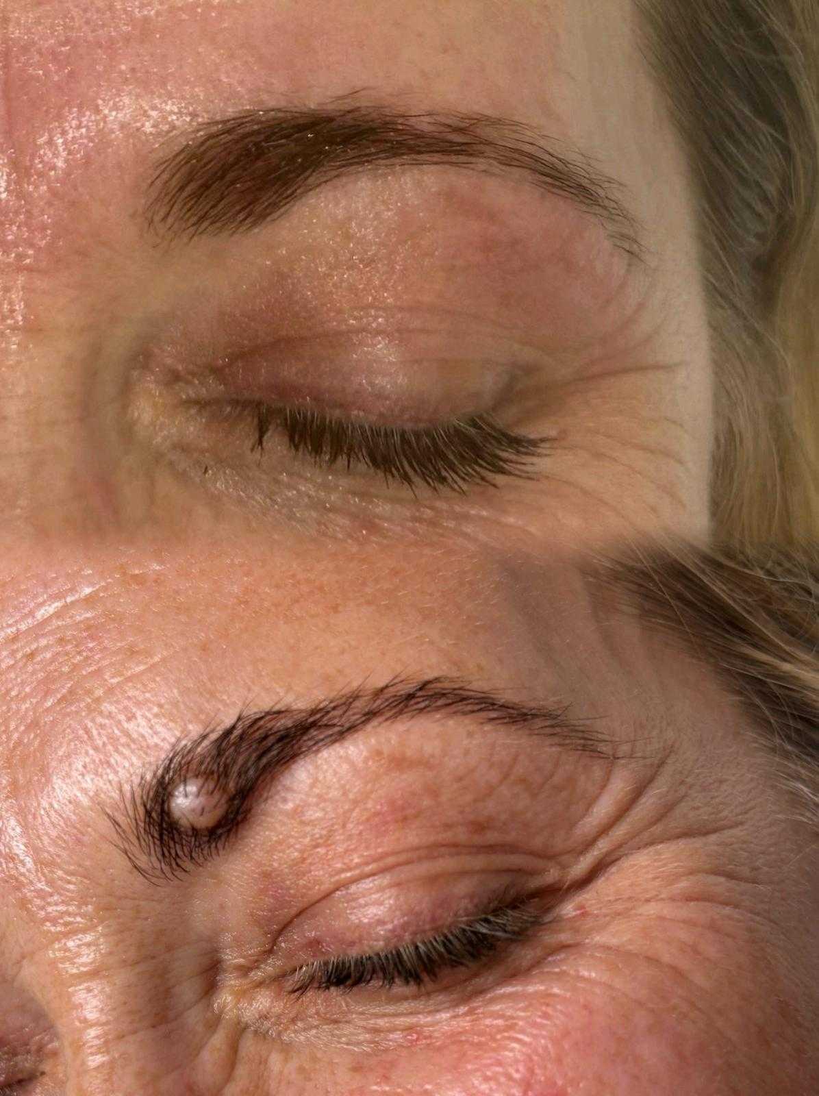 Plasma pen — mole removal — Healed result following plasma pen mole removal.